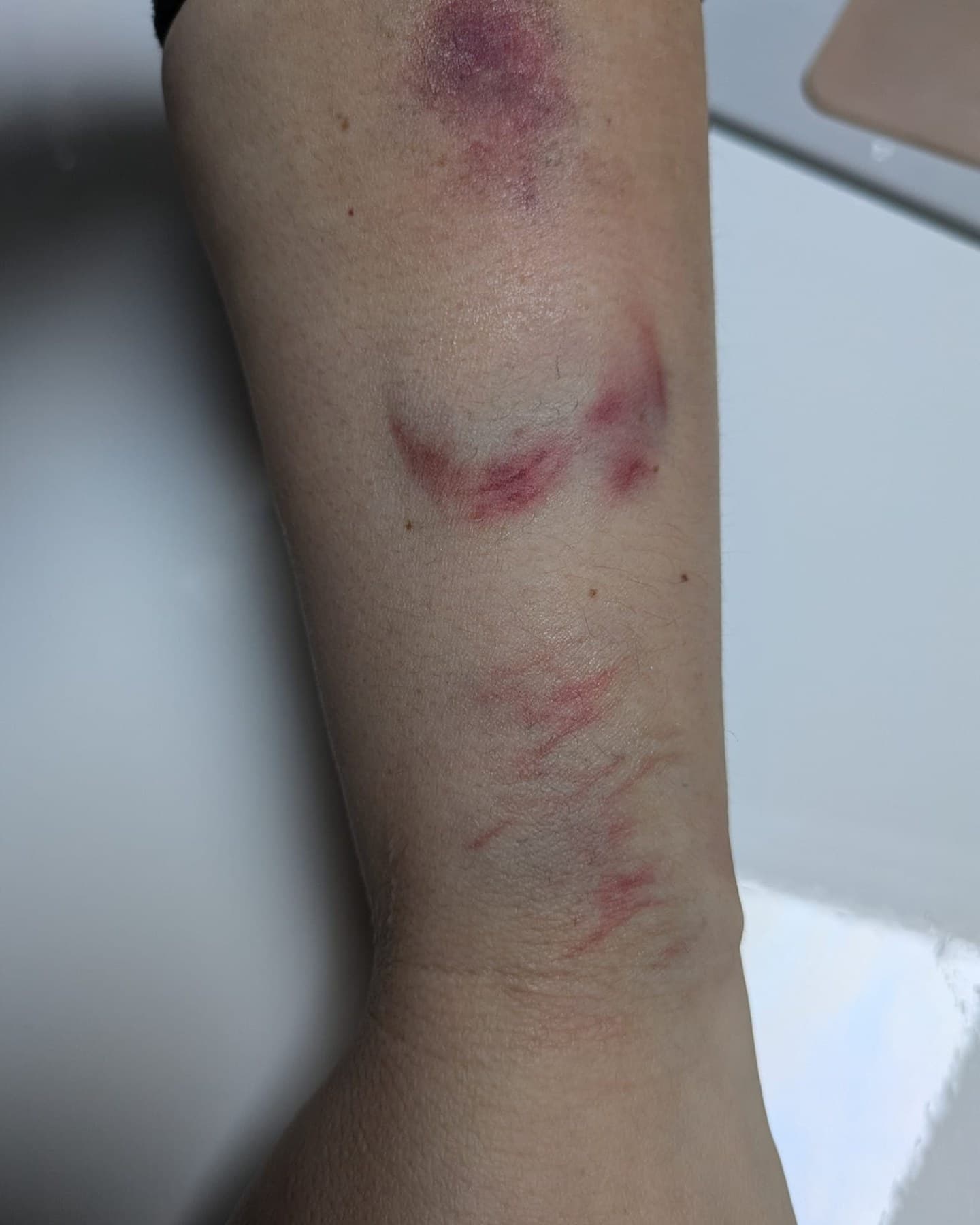 Bruise & abrasions · Forearm
