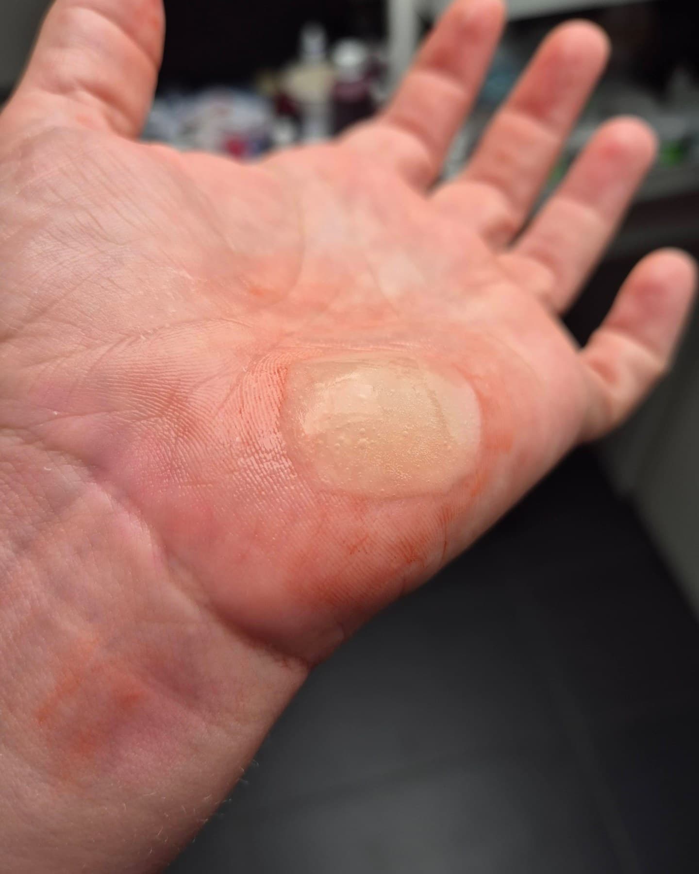 Burn blister · Palm