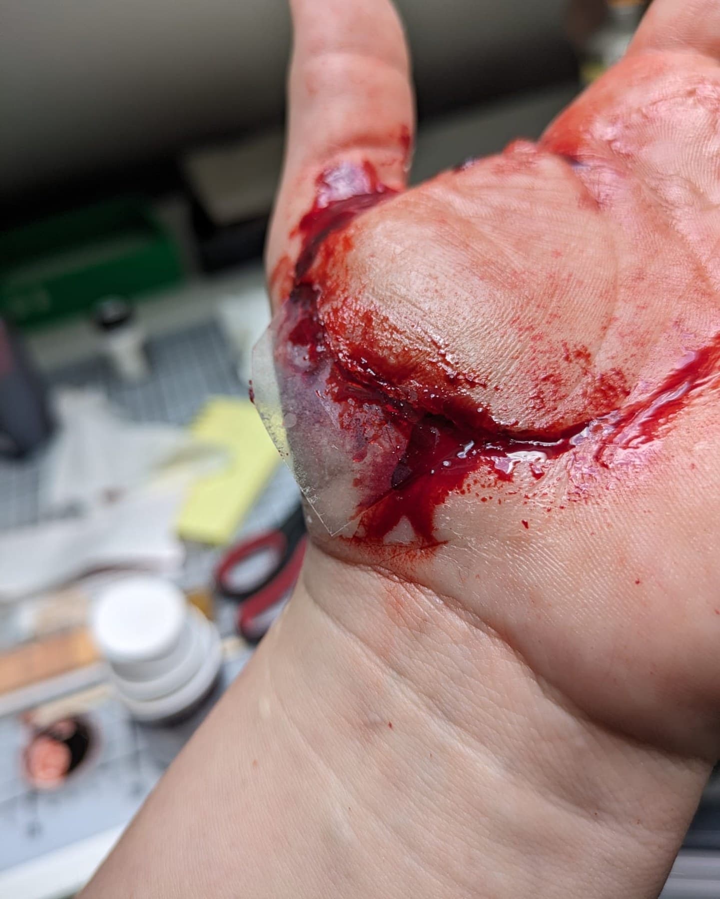 Laceration · Hand