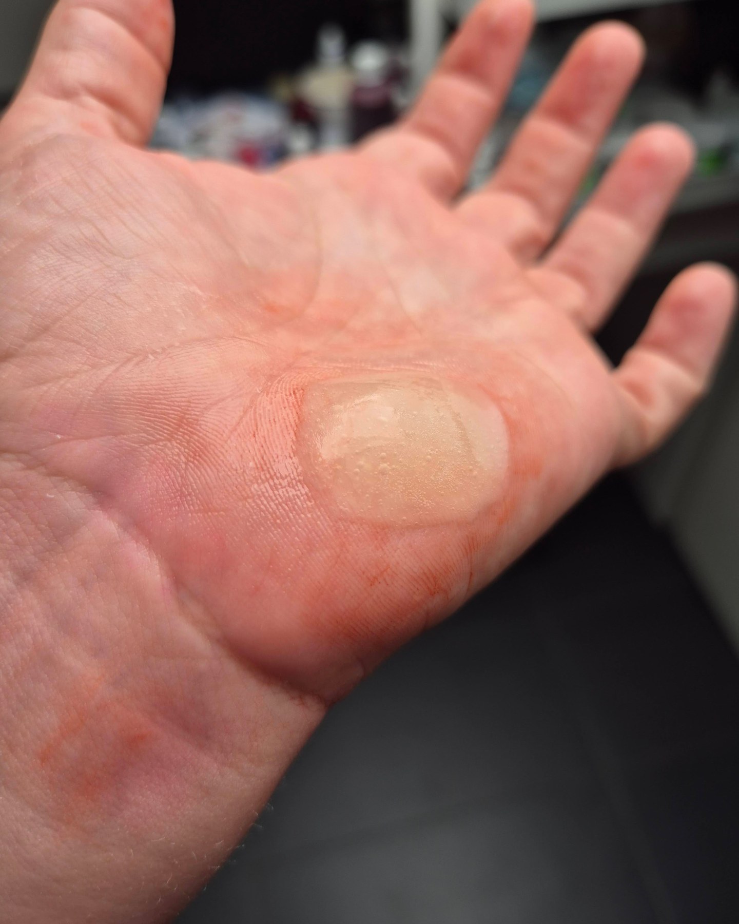 Brandblase · Handfläche